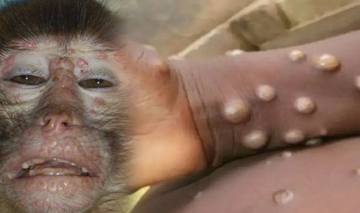 Avusturya’da 2 maymun çiçeği virüsü daha tespit edildi