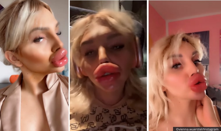 Viyanalı Influencer Dudaklarına Yılda 15.000 Euro Harcıyor