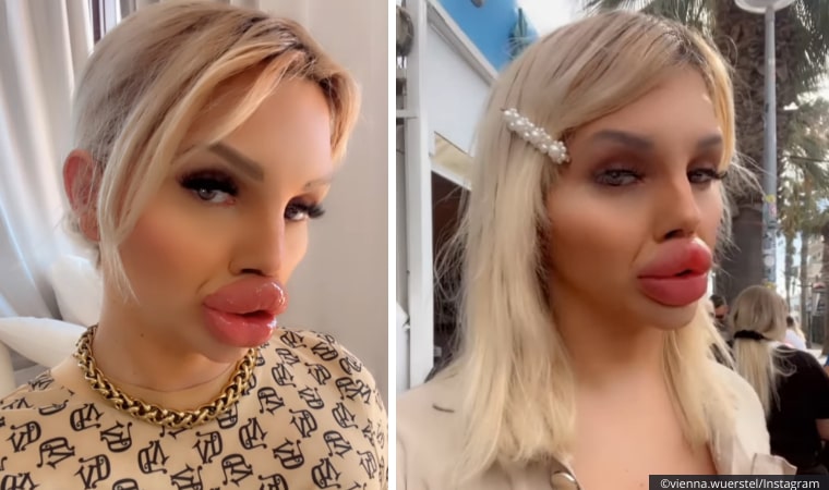 Viyana’da 30 Mililitre Dudak Dolgusu Yaptıran Genç Kız, Artık Yemek Yiyemiyor