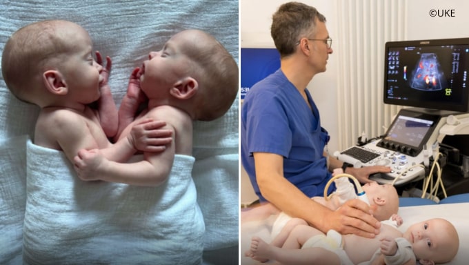 Almanya’da Birleşik İkizler Hamburg-Eppendorf Üniversitesi Hastanesi’nde Başarıyla Ayrıldı