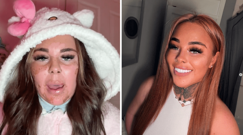 Solaryumda Ters Pozisyonda Yatan 23 Yaşındaki Influencer Ciddi Yanıklar Aldı!